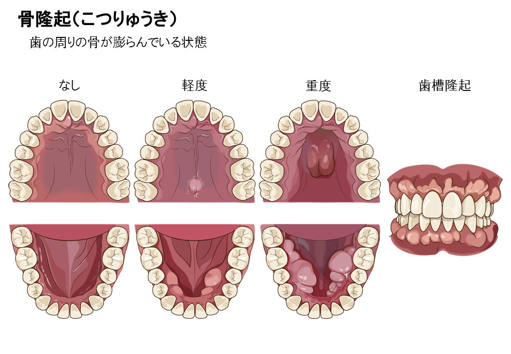 骨隆起