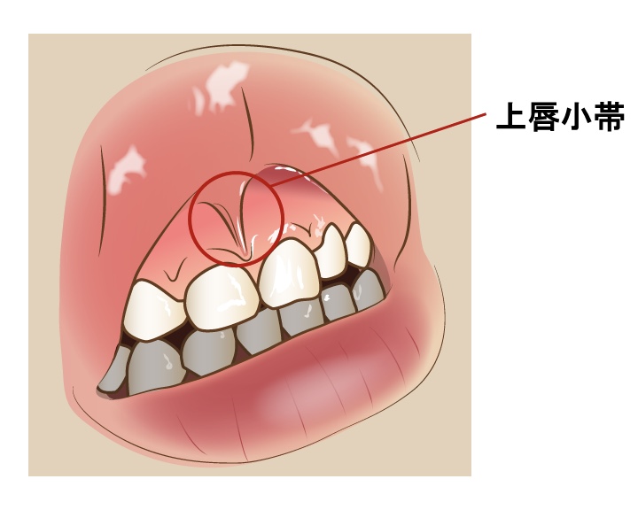 上唇小帯